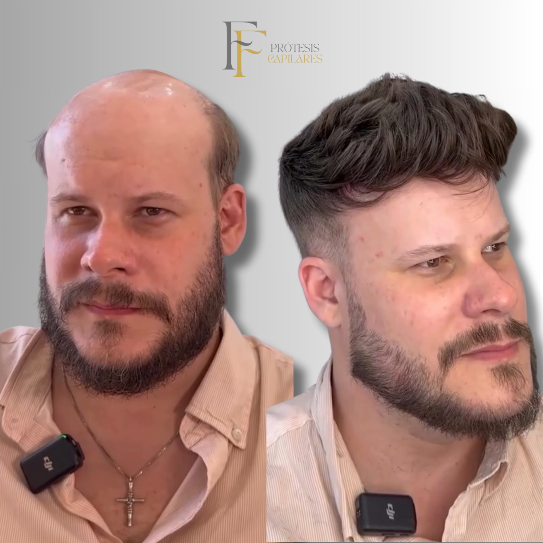 FF Custom - Prótesis Capilar Premium
