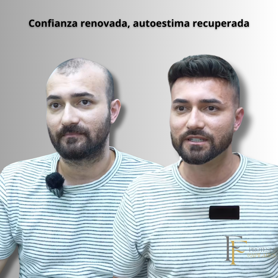 FF Custom - Prótesis Capilar Premium