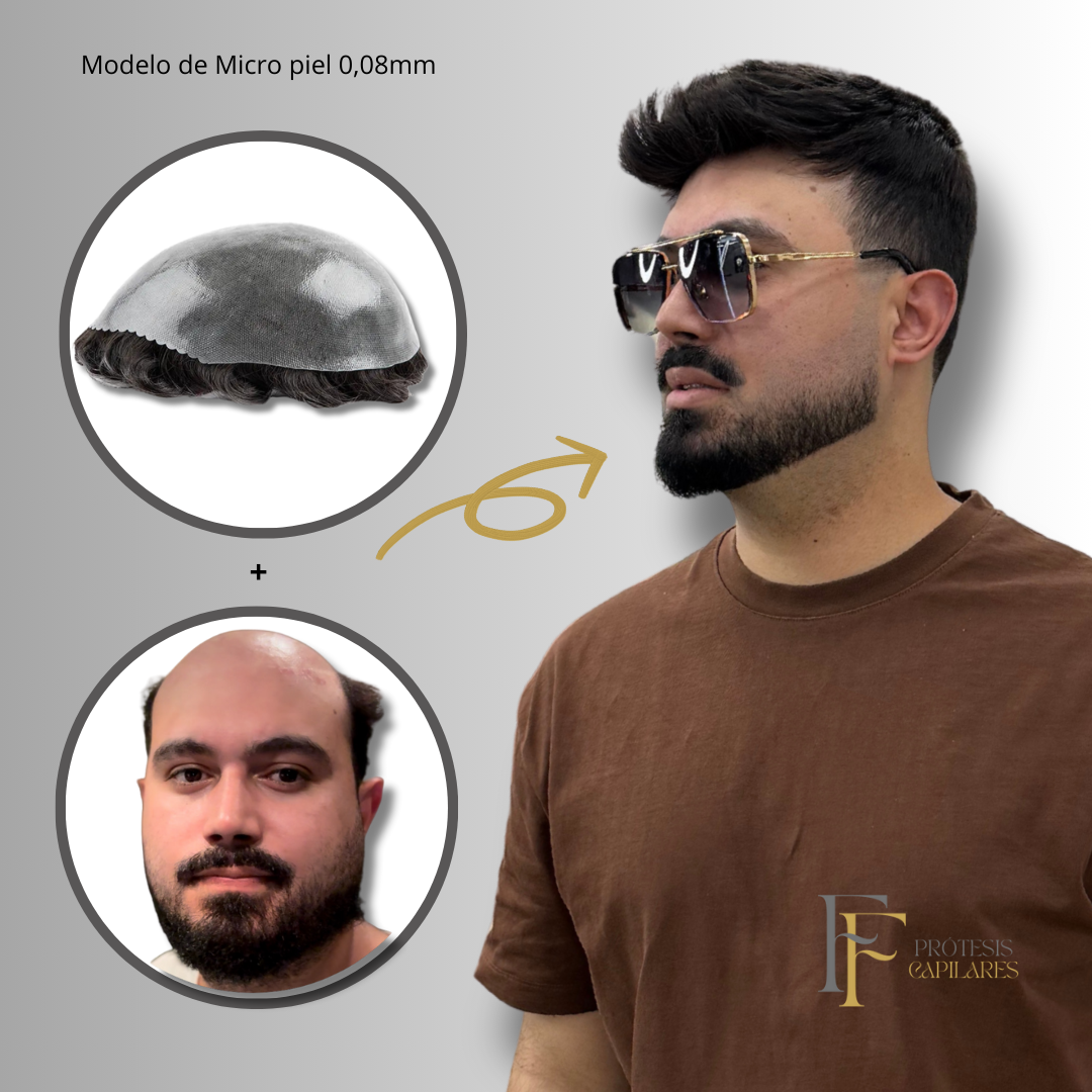 FF Custom - Prótesis Capilar Premium